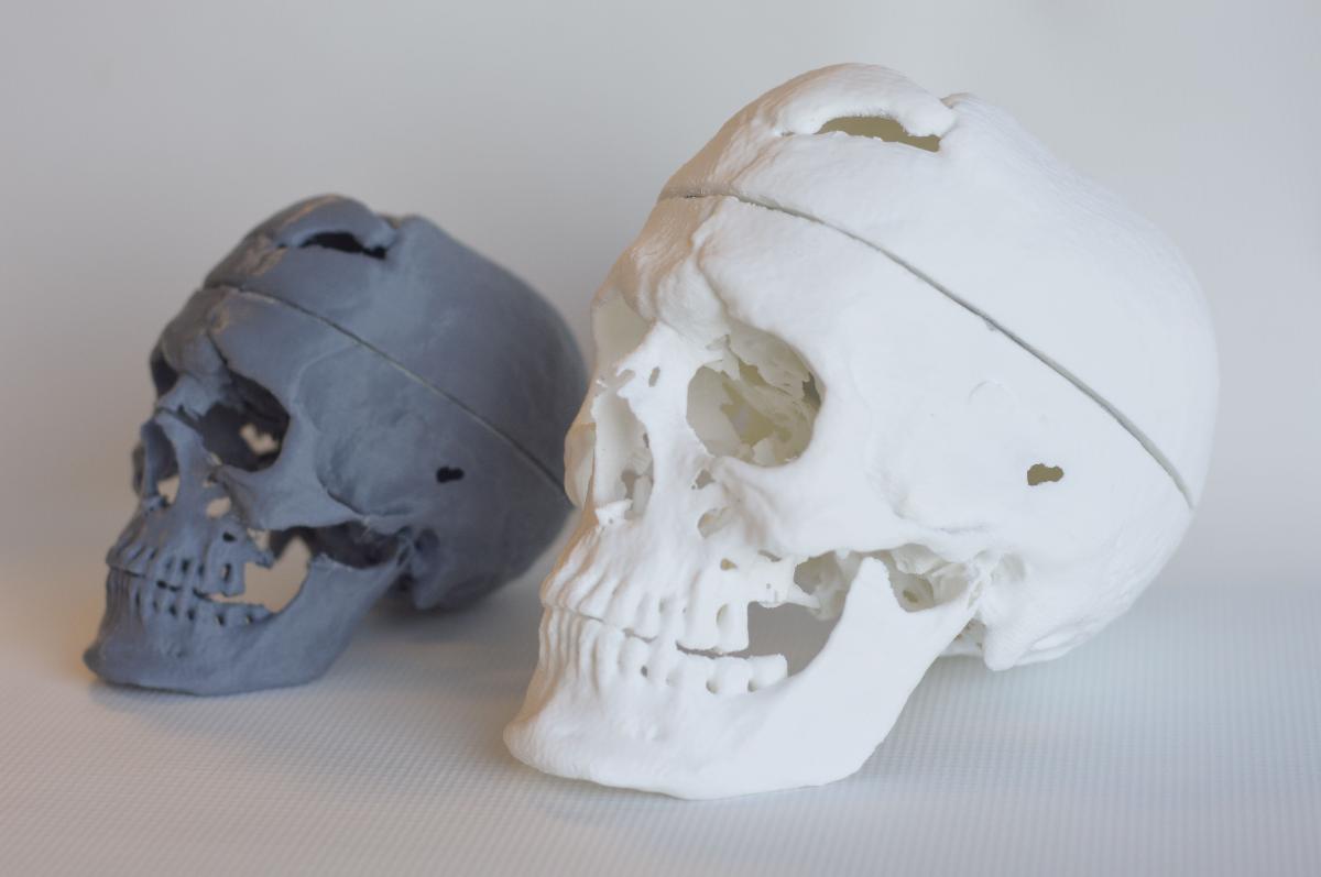 Craneo de Phineas Gage