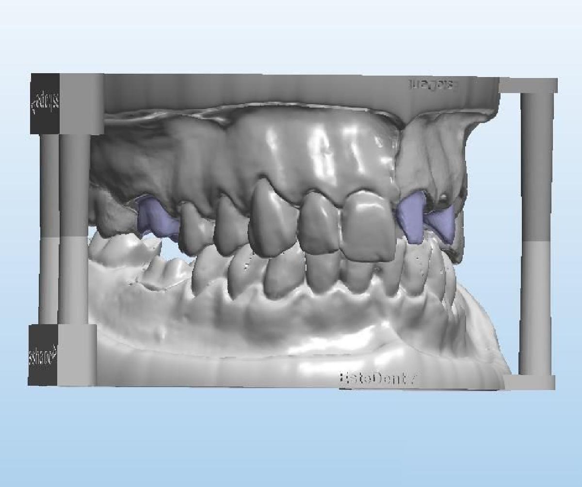 Modelo dentário+Antagonista+3 dentes