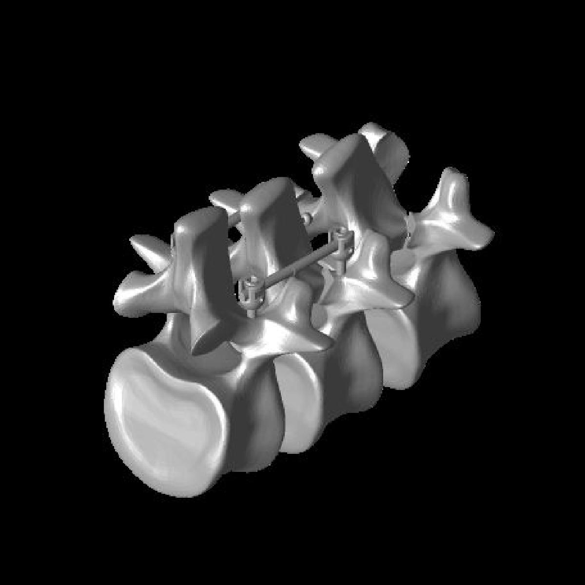 Spondy dupla deker pediculo abaixo das pars modelos.stl