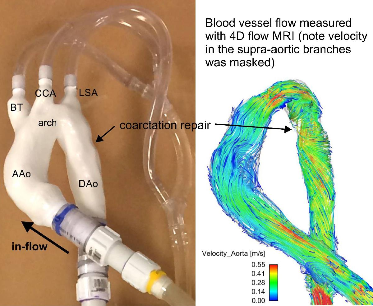 Coarctacao da aorta reparada cirurgicamente (modelo de fluxo)