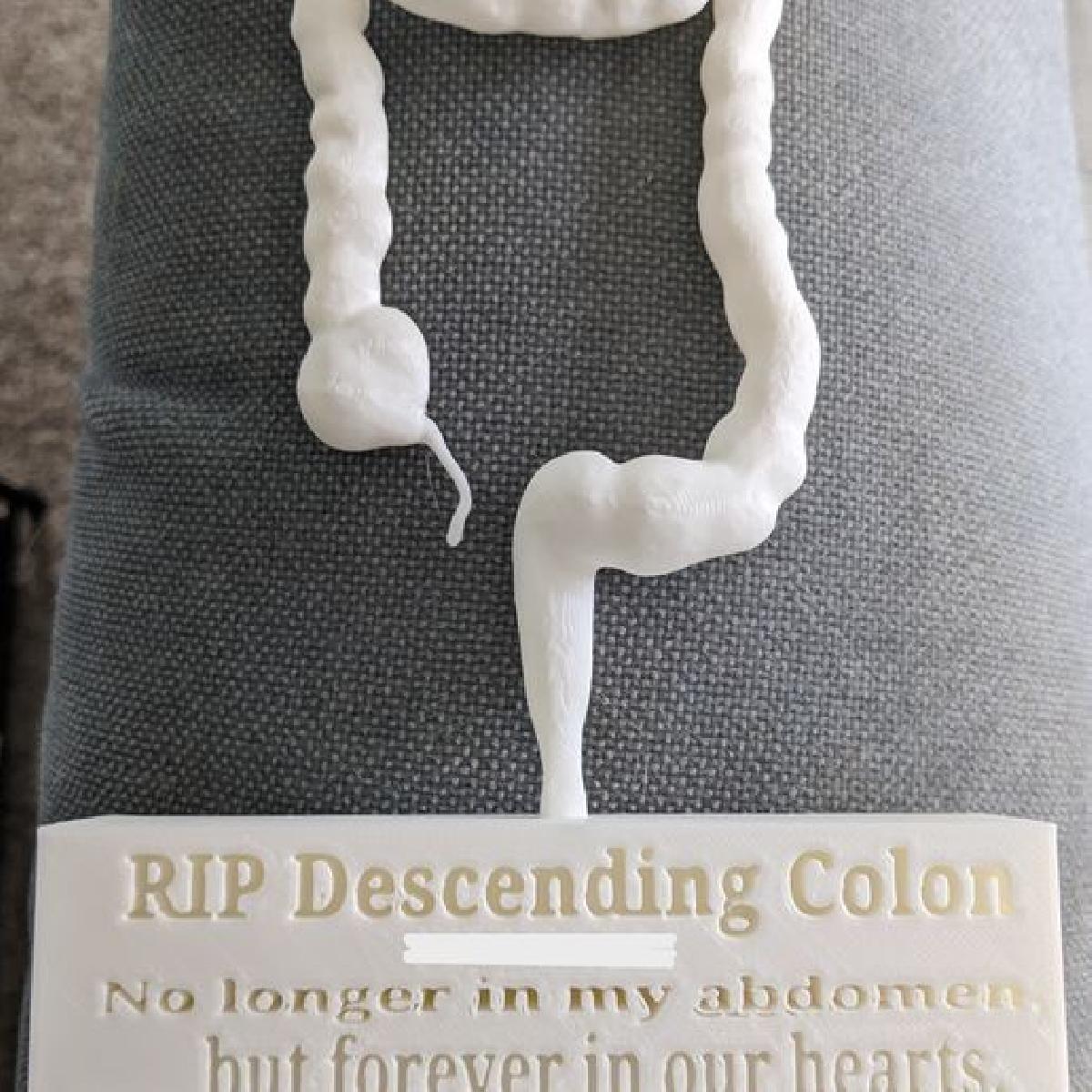 Colectomia (Ressecao Intestinal) e Apendicectomia Memorial